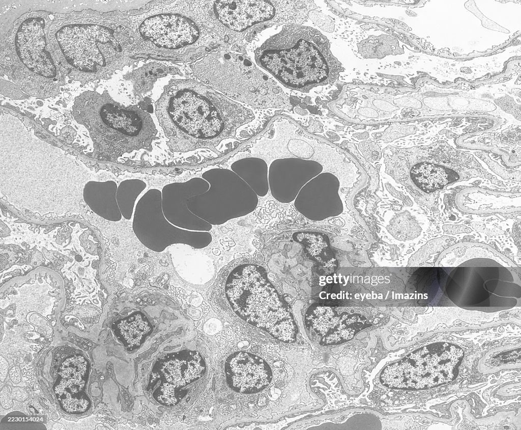 Transmission electron micrograph of a glomerulus from a renal biopsy