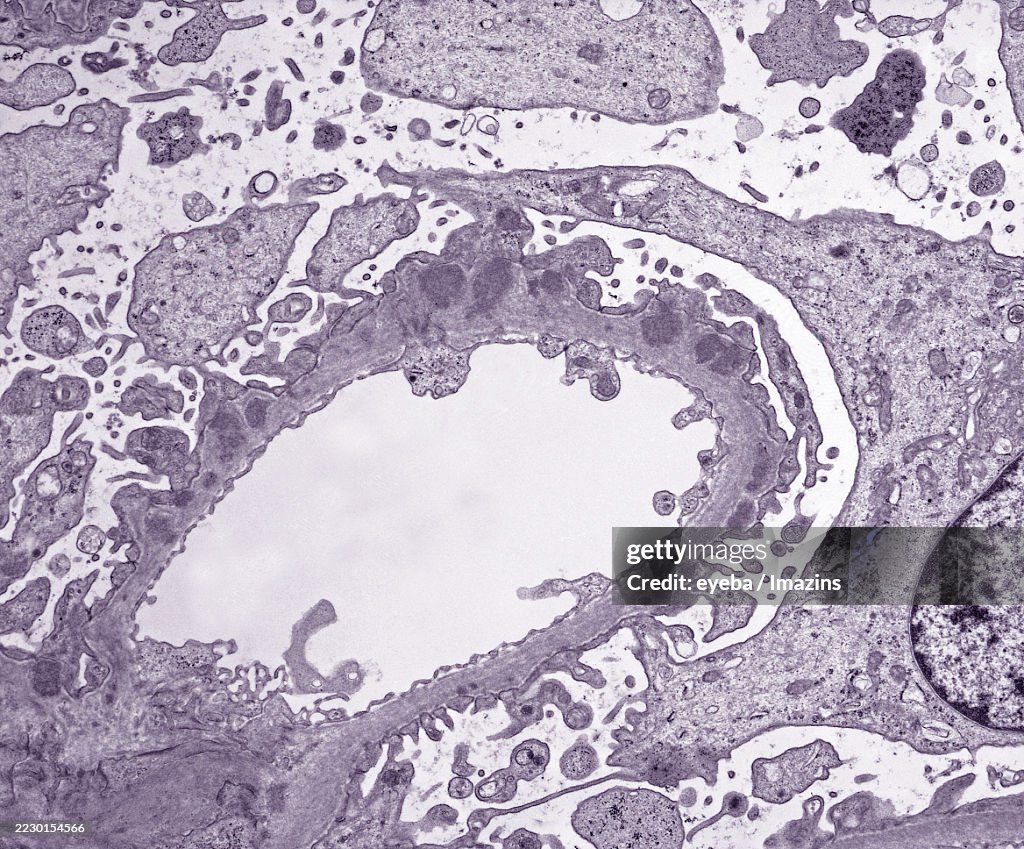 Electron micrograph showing depositions of immune protein found in the basement membrane of a cross-section of a glomerular capillary in the kidney