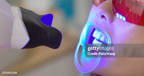 trattamento di sbiancamento dei denti a led - sbiancamento dentale foto e immagini stock