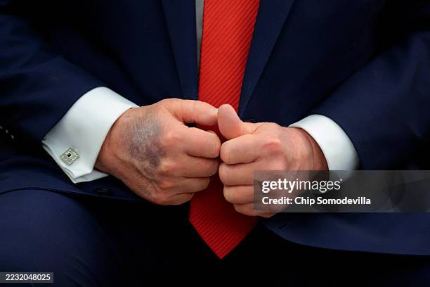 Bruise is visible on the back of U.S. President Donald Trump's right hand during a meeting with South Korean President Lee Jae-myung in the Oval...