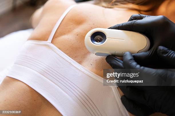 dermatóloga examinando a su paciente con un dermatoscopio - melanoma fotografías e imágenes de stock