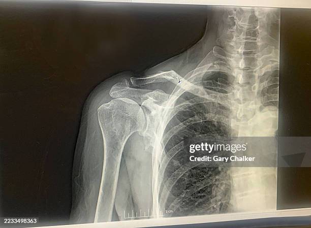 shoulder x-ray - clavicle stock pictures, royalty-free photos & images