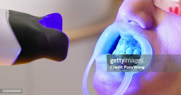 il dentista anziano procede con il trattamento di sbiancamento dei denti - sbiancamento dentale foto e immagini stock