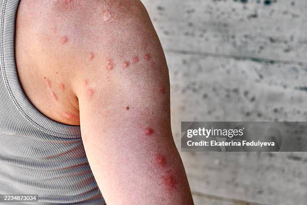 Varicell Raction Rash 337 Varicella Zoster Virus Stock Photos, High-Res Pictures, and Images ...