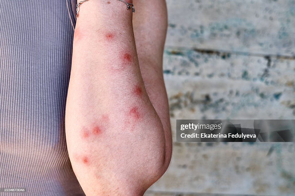 Human hand skin covered in red, itchy rash with multiple bites, symptoms eczema, chickenpox, dermatitis, allergic reaction due to insect bites.