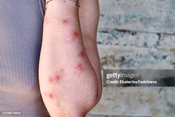 Varicell Raction Rash 337 Varicella Zoster Virus Stock Photos, High-Res Pictures, and Images ...