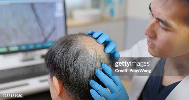 medico che esamina l'uomo calvo - calvizie foto e immagini stock
