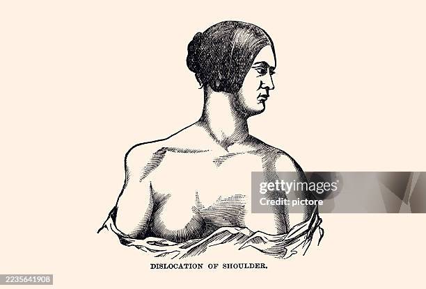 dislocation of shoulder : a shoulder dislocation occurs when the upper arm bone (humerus) pops out of the shoulder socket... - deformed hand stock illustrations