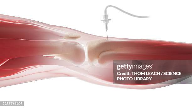 intraosseous infusion in shin bone, illustration - bone marrow stock illustrations