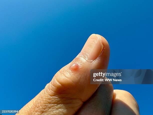 mucous cyst on the thumb - cyst stock pictures, royalty-free photos & images