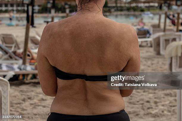 back view of a middle-aged woman with visible skin condition on shoulders and upper back, standing on a sandy beach in swimwear, highlighting uneven skin tone and texture, skin sun damage - hyperpigmentation stockfoto's en -beelden