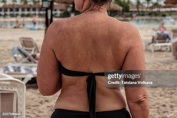 back view of a woman with visible skin condition and uneven tone on shoulders and upper back, standing on the beach in swimwear, concept of sun exposure, dermatology, and real skin texture - hyperpigmentation stockfoto's en -beelden