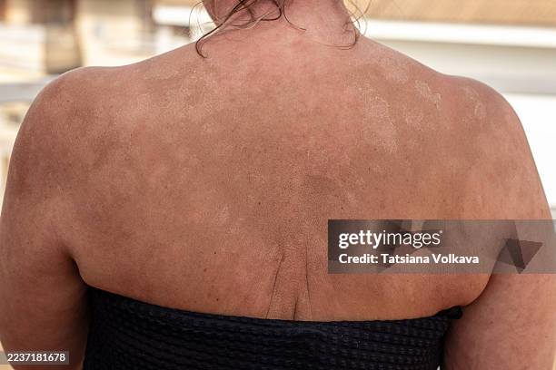 close-up back view of a woman with visible skin peeling and discoloration on shoulders, concept of sunburn, uv damage, dermatology, skin care, and real human skin texture - hyperpigmentation stockfoto's en -beelden
