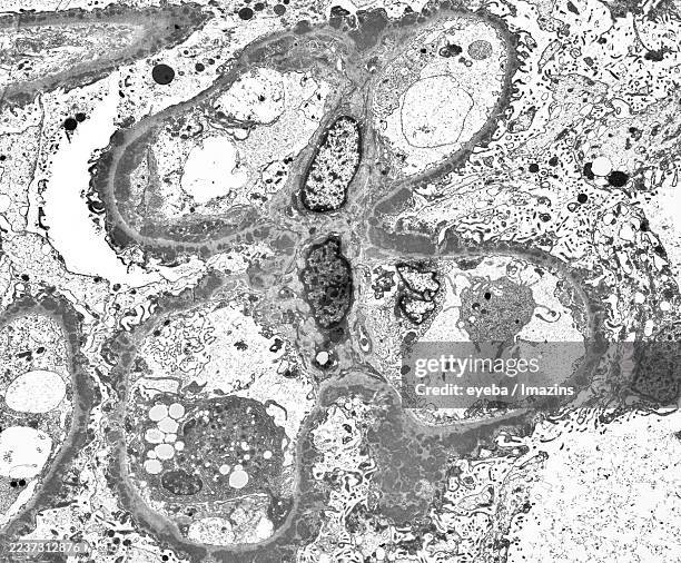 nephritis, glomerulus, proteinuria electron micrograph of protein-deposited basement membrane of a nephritic glomerulus, 2,000x - electron micrograph stock pictures, royalty-free photos & images