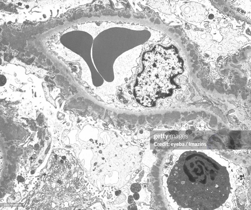Electron micrograph of protein-deposited basement membrane of a nephritic glomerulus, 3,500x