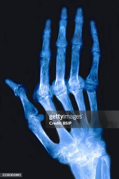 Rheumatoid arthritis Chronic rheumatic arthritis - Chronic progressive polyarthritis This disease is the cause of ankylosis and bone deformities....