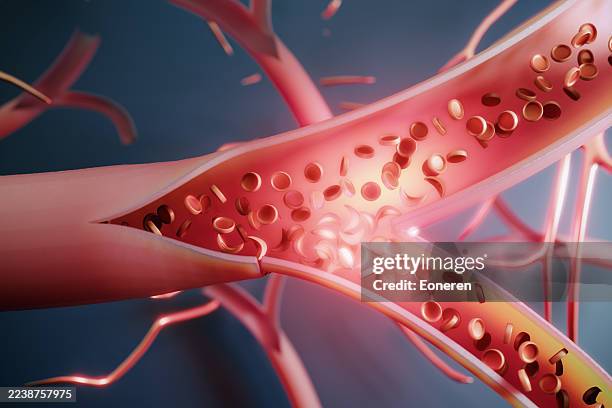 sickle cell anemia - bloedsomloop stockfoto's en -beelden