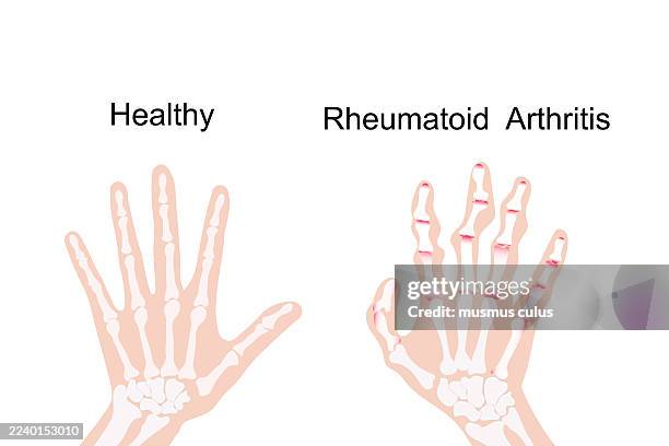 comparison of healthy hand and rheumatoid arthritis — medical illustration - rheumatoid arthritis stock illustrations