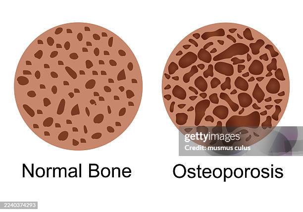 stockillustraties, clipart, cartoons en iconen met comparison between normal bone and osteoporosis – illustration of bone density loss - osteoporose