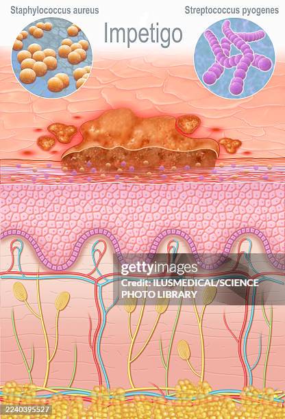 impetigo, illustration - group a streptococcus stock illustrations