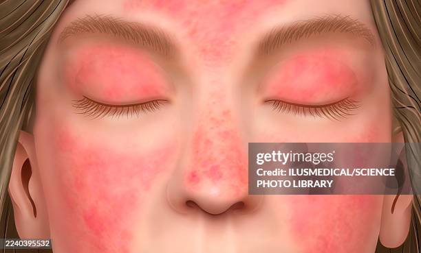 stockillustraties, clipart, cartoons en iconen met dermatomyositis and skin rash on the face, illustration - wang