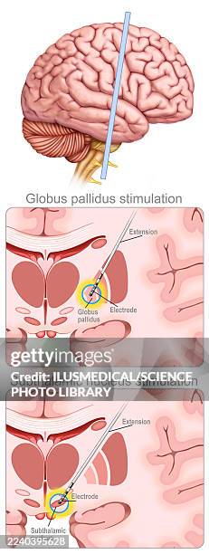 electrical brain neurostimulator, illustration - pacemaker stock illustrations