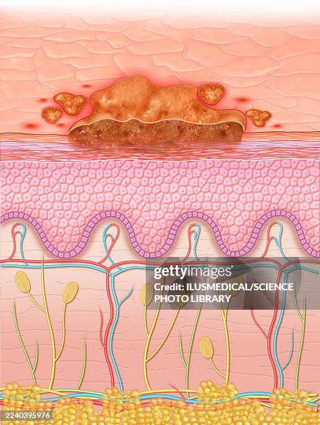 Scab Vector 29 ilustraciones en alta resolución sobre Nose Injury - Getty Images