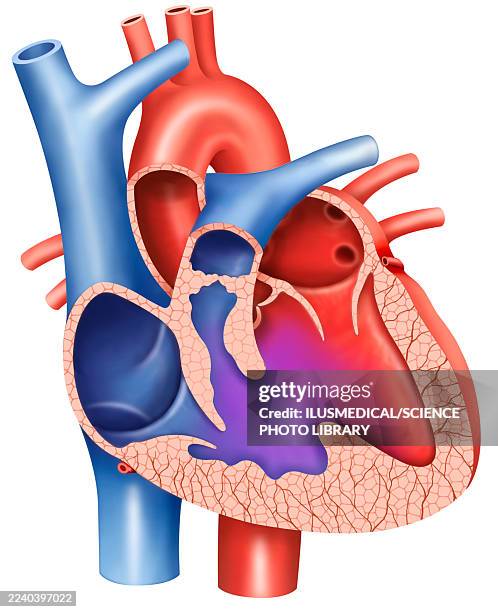 ilustraciones, imágenes clip art, dibujos animados e iconos de stock de tetralogy of fallot and ventricular septal defect, illustration - ventrículos del corazón