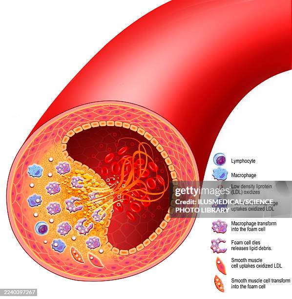 illustrazioni stock, clip art, cartoni animati e icone di tendenza di rupture of an atheromatous plaque, illustration - macrofago