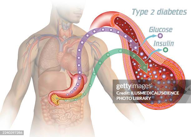 insulin deficiency and type 2 diabetes, illustration - homeostasis stock illustrations