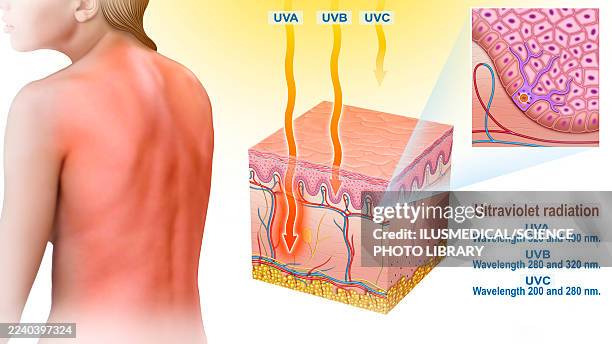 ultraviolet light damaging the skin, illustration - sunburn stock illustrations