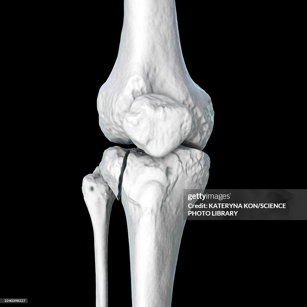 Tibia fracture Schatzker type I, illustration