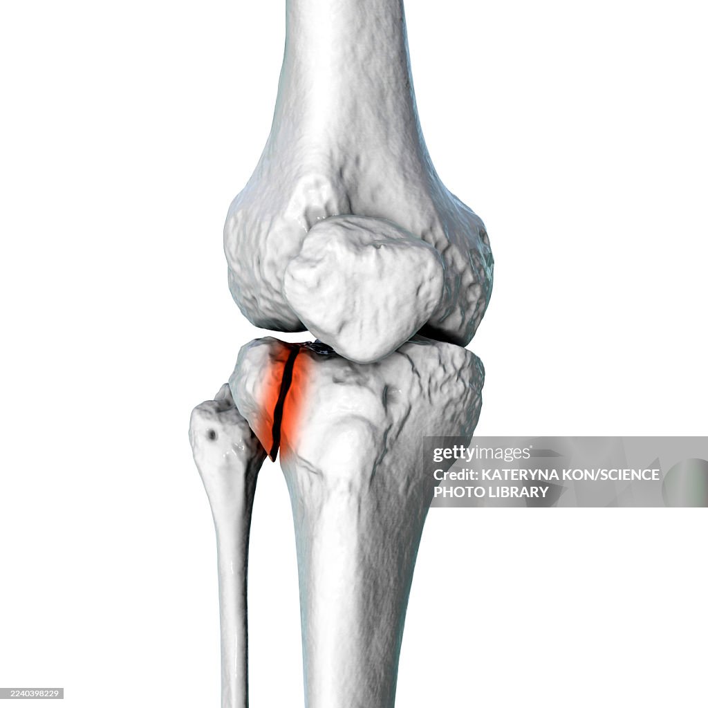 Tibia fracture Schatzker type I, illustration