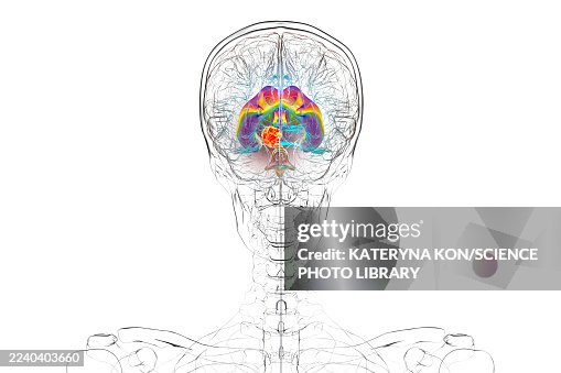 A brain tumor causing hydrocephalus, illustration A brain tumor causing hydrocephalus, illustration