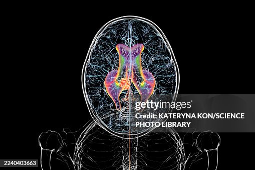 A brain tumor causing hydrocephalus, illustration A brain tumor causing hydrocephalus, illustration