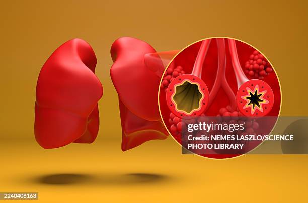 normal and asthmatic bronchioles in lung, illustration - bronchialbaum stock-grafiken, -clipart, -cartoons und -symbole