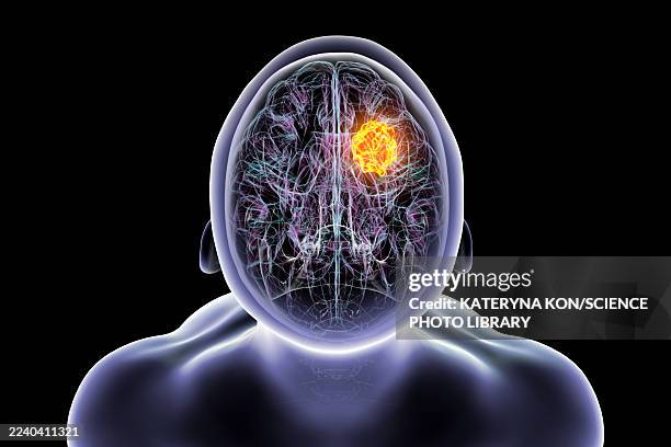 brain tumour, illustration - hirntumor stock-grafiken, -clipart, -cartoons und -symbole
