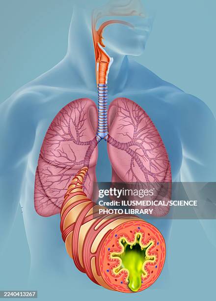 inflamed airways due to acute bronchitis, illustration - bronchitis stock illustrations