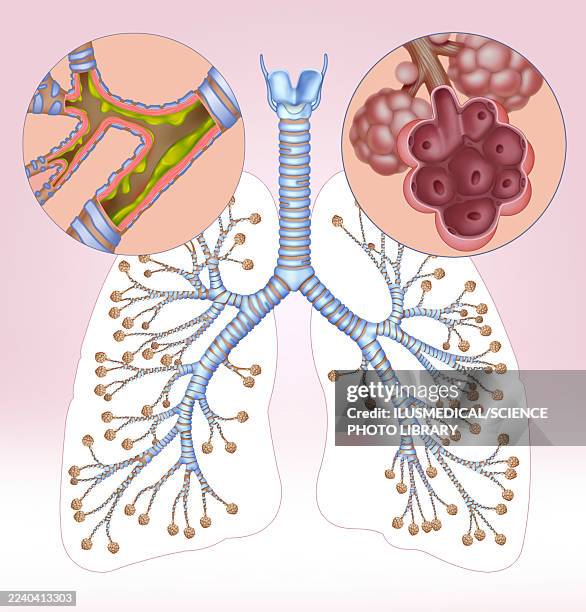 emphysema and bronchitis, illustration - copd stock illustrations
