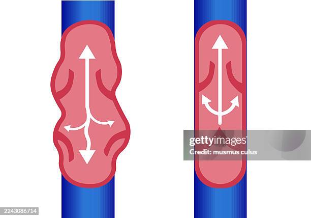 illustrations, cliparts, dessins animés et icônes de comparaison des varices saines et des varices - illustration du flux sanguin - jambe