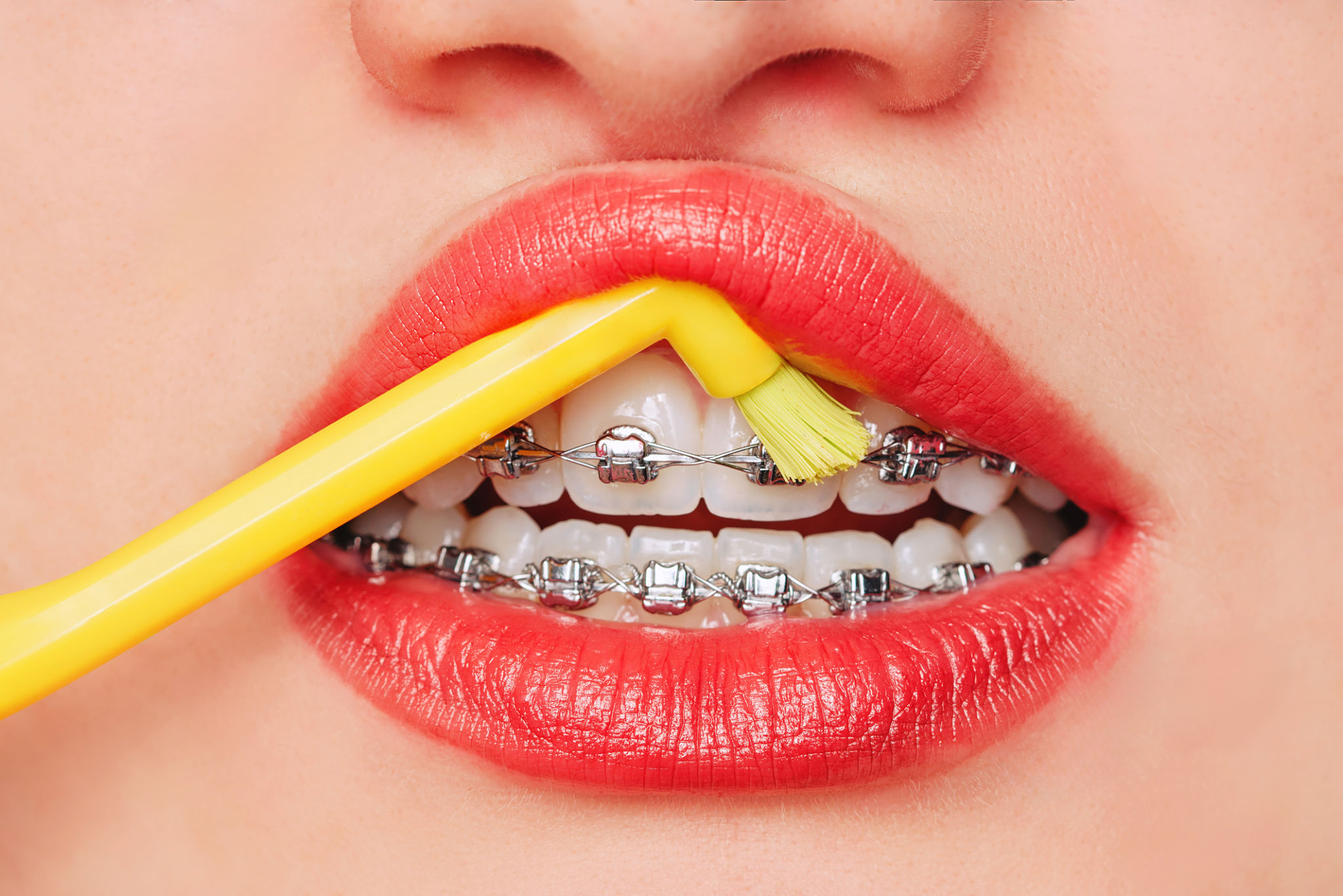 braces cleaning tools