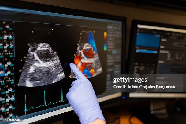 arzt analysiert den ultraschall des echokardiogramms auf dem monitor - echokardiogramm stock-fotos und bilder