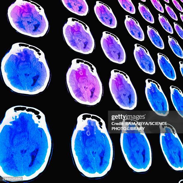 brain tumour, ct scans - condition stock pictures, royalty-free photos & images