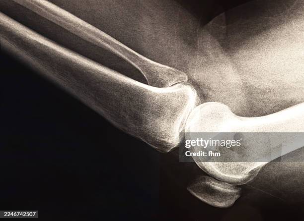 x-ray image of a knee joint with thigh and shin bone - osteoporosis fotografías e imágenes de stock