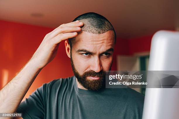 young adult man checking hair after transplant procedure - calvizie foto e immagini stock