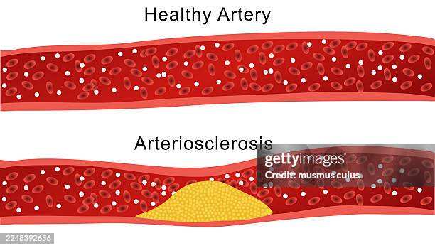 stockillustraties, clipart, cartoons en iconen met healthy artery vs. arteriosclerosis – medical cross-section illustration - coronary arteries diagram