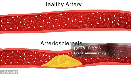 Healthy Artery vs. Arteriosclerosis – Medical Cross-Section Illustration Healthy Artery vs. Arteriosclerosis – Medical Cross-Section Illustration