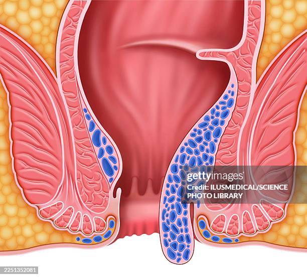 advanced internal haemorrhoids, illustration - hemorrhoid treatment stock illustrations
