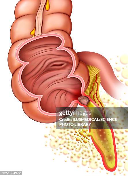 ruptured appendicitis, illustration - appendix stock illustrations