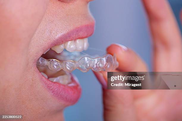 woman puts on an invisible silicone teeth aligner. invisible dental braces for teeth correction - tooth whitening stock pictures, royalty-free photos & images
